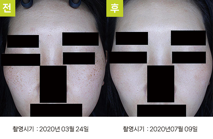 주근깨 증례4 전후 ② — 오오집중색소치료프로그램 1사이클 피부 톤 개선