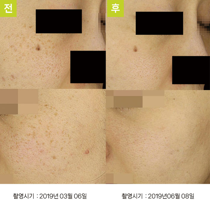 대구주근깨레이저 증례5 전후 — 연한 주근깨 오오색소토닝 10회 호전