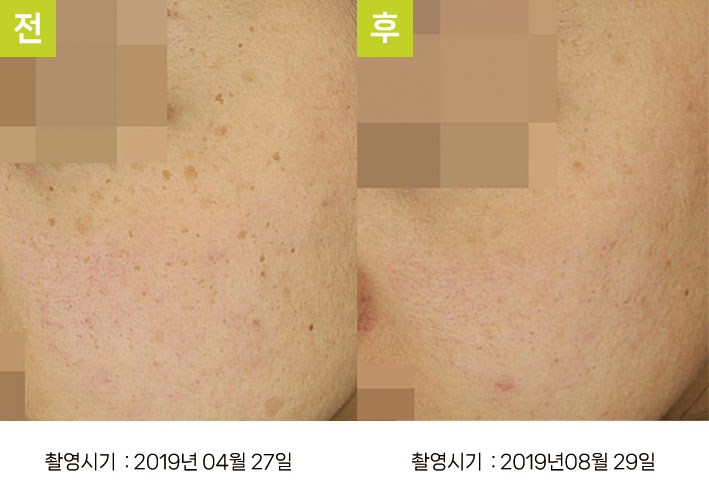 주근깨 증례5 전후 ② — 연한 주근깨 오오색소토닝 10회 대구주근깨제거