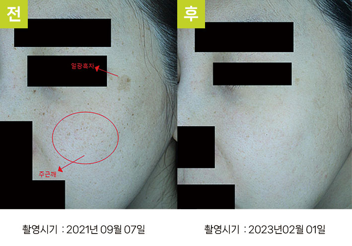 대구주근깨제거 증례6 전후 — 주근깨와 일광흑자 오오집중색소치료프로그램 1사이클