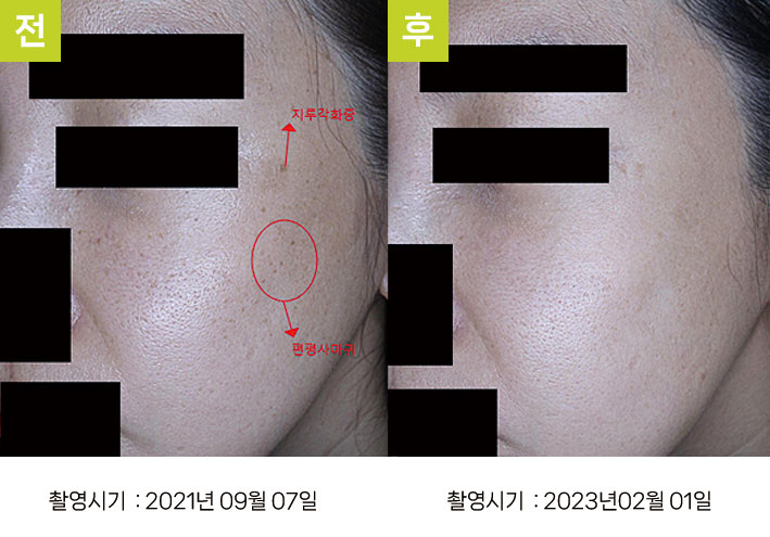 주근깨 일광흑자 증례6 전후 ② — 오오집중색소치료프로그램 피부 톤 개선