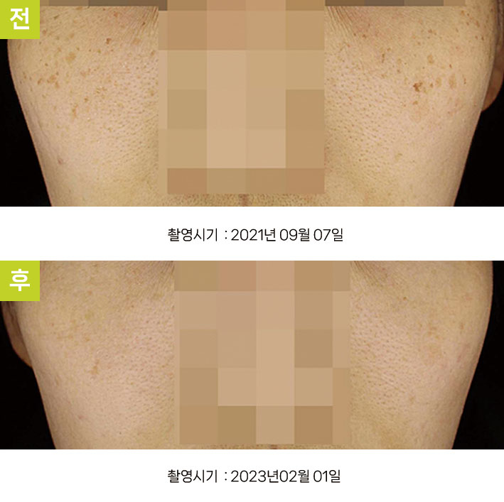 대구주근깨피부과 증례7 전후 — 주근깨와 흑자증 오오집중색소치료프로그램 1사이클