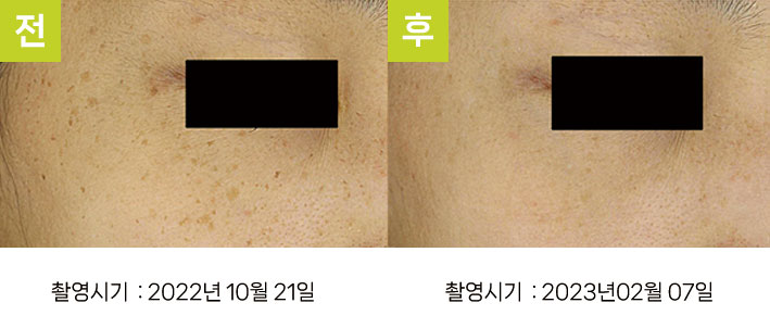 주근깨 흑자증 증례7 전후 ② — 오오집중색소치료프로그램 호전