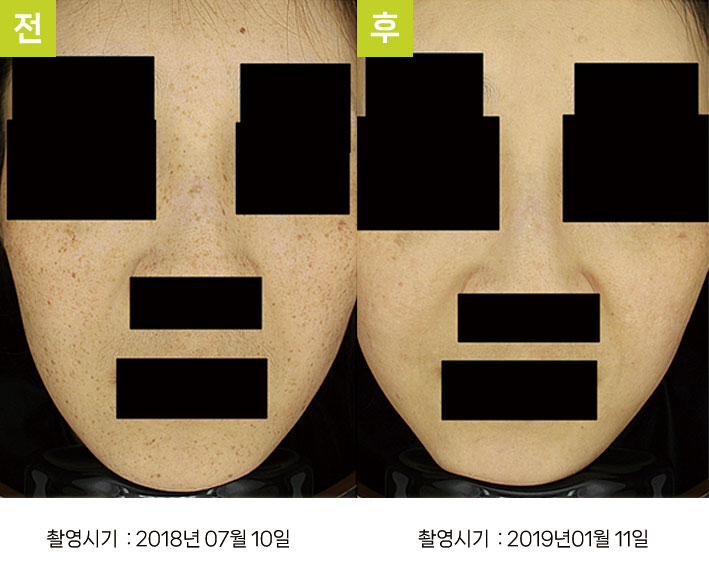 대구주근깨레이저 증례8 전후 — 오오색소토닝 10회 주근깨 호전