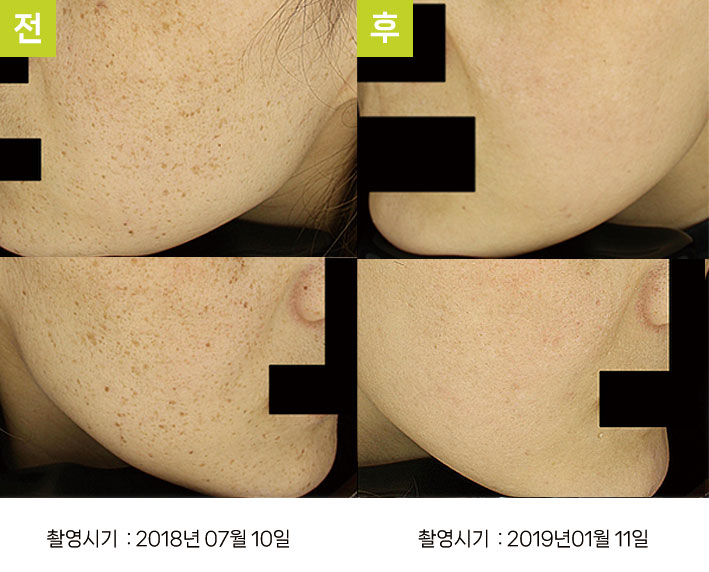 주근깨 증례8 전후 ② — 오오색소토닝 10회 대구주근깨제거