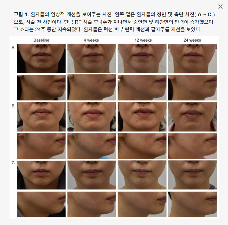 대구올리지오 단극성 고주파 리프팅 임상연구 — 피부 탄력 하안면 처짐 개선