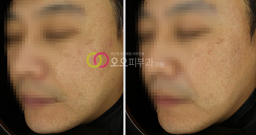 Sagger 타입 복합 리프팅 시술 전