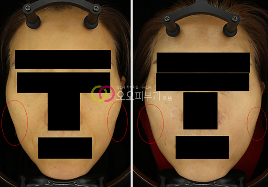 관자·뒷볼 꺼짐 필러 시술 전
