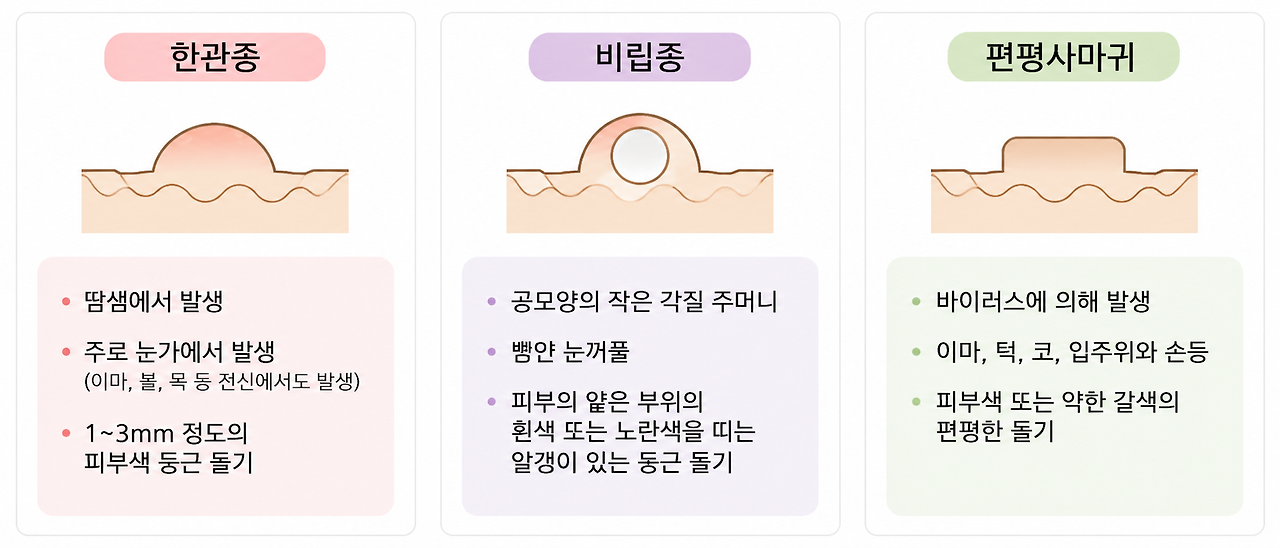 비립종 예시