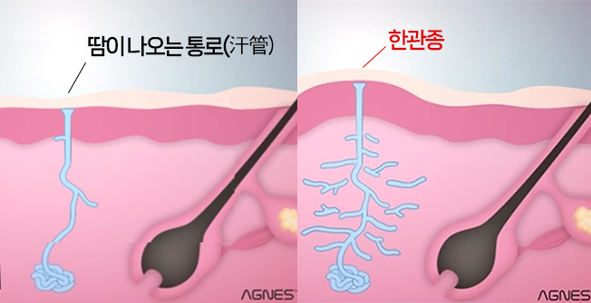 대구한관종 정상 한관과 한관종 비교 일러스트