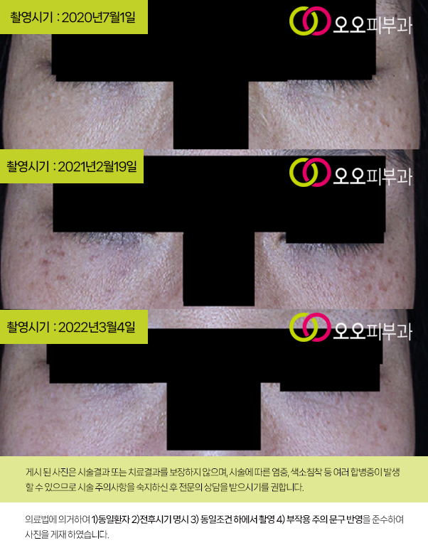 대구한관종 제거 실제 치료 경과