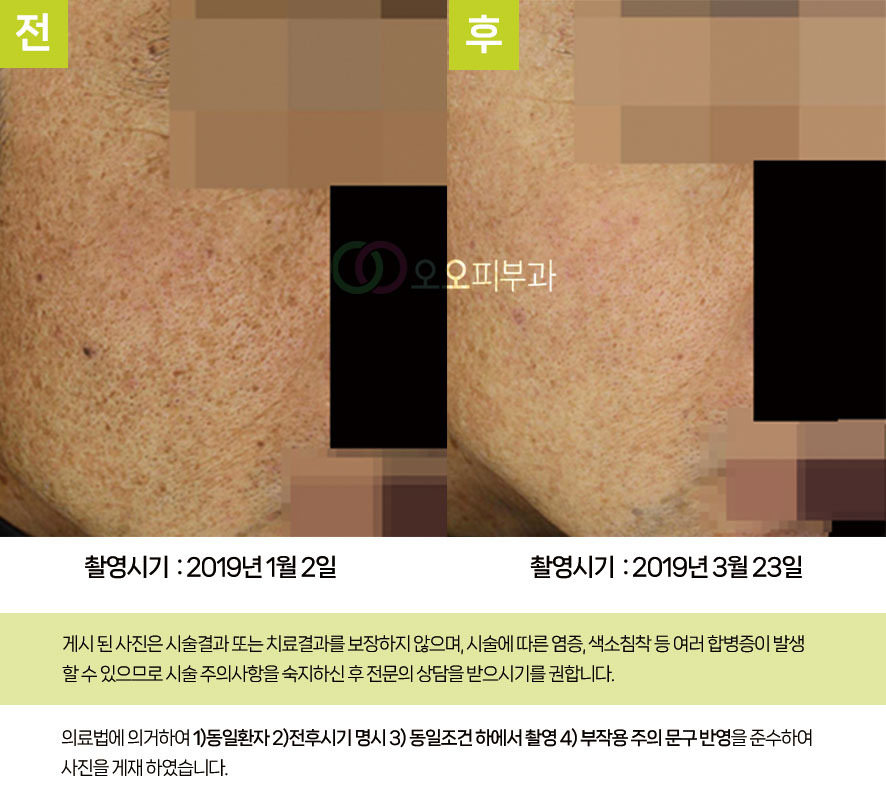 대구흑자치료 1064 색소 레이저 반복 치료
