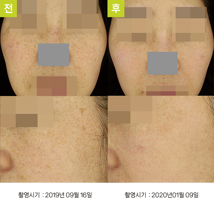 대구난치성기미 오오피부과 - 옅은 기미·다발성 흑자증 증례1 정면 전후