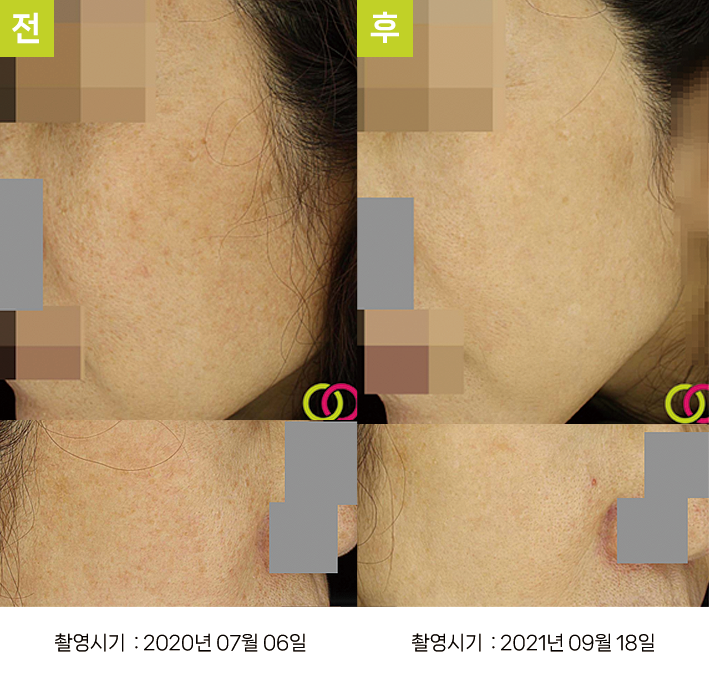 대구난치성기미 오오피부과 - 흑자증·옅은 기미 증례10 측면 전후