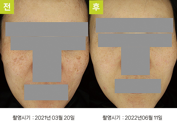 대구난치성기미치료 오오피부과 - 난치성 기미 듀얼토닝 증례11 정면 전후