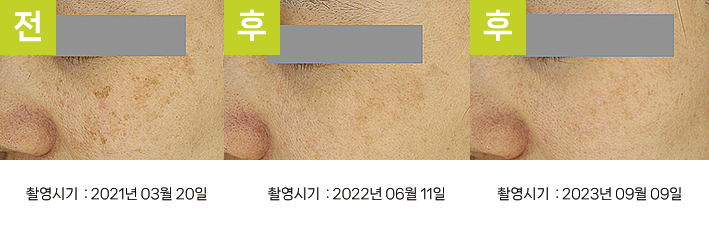 대구난치성기미치료 오오피부과 - 난치성 기미 듀얼토닝 증례11 볼 3시점