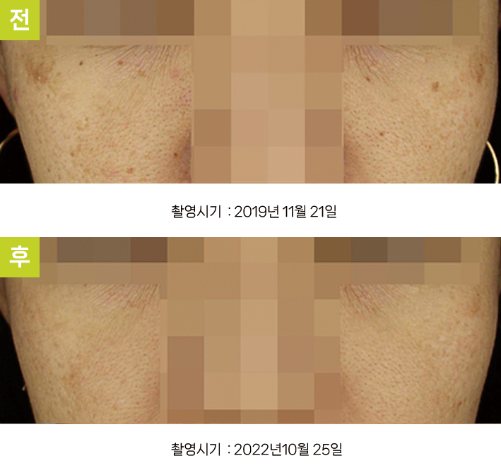 대구재발성기미 오오피부과 - 눈가 기미·일광흑자 증례12 전후