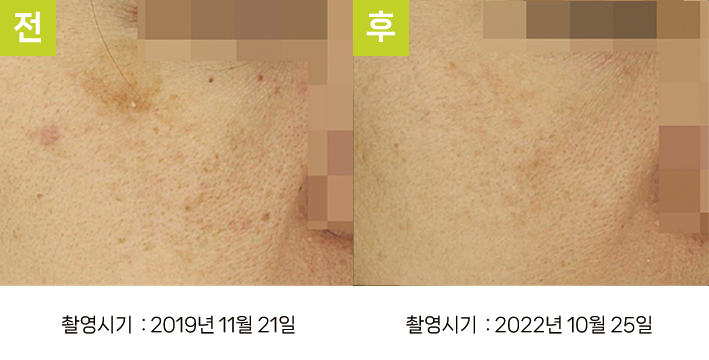 대구재발성기미 오오피부과 - 눈가 기미·일광흑자 증례12 볼 전후