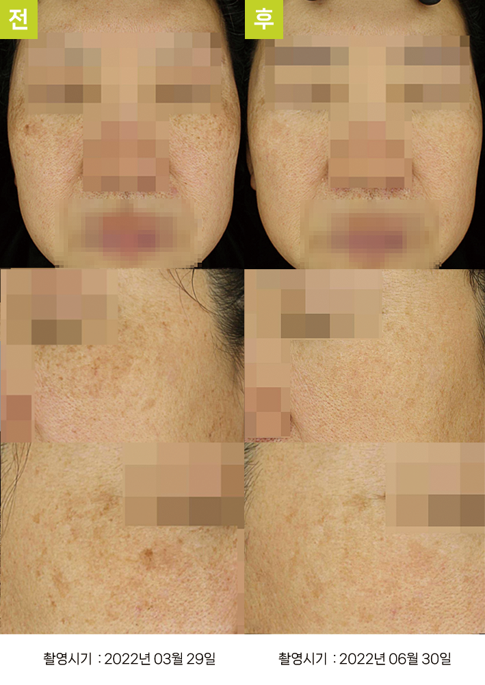 대구난치성기미 오오피부과 - 흑자증·옅은 기미 증례13 정면 전후