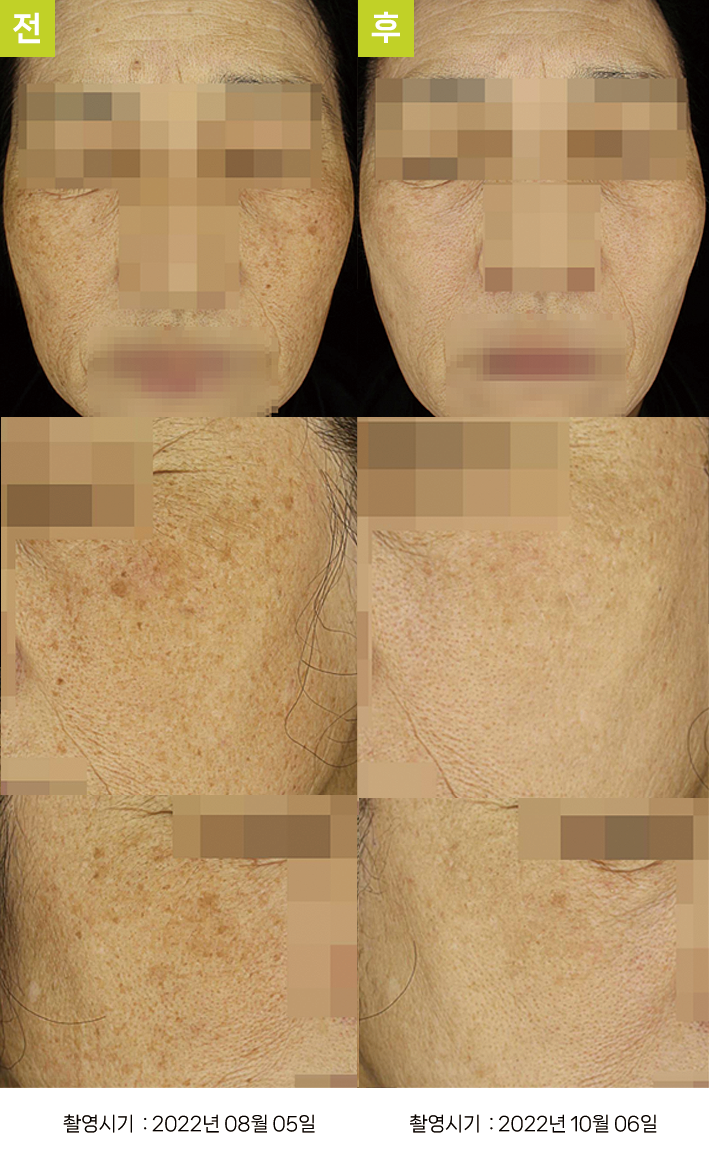 대구난치성기미 오오피부과 - 다발성 흑자증·광노화 증례15 정면 전후