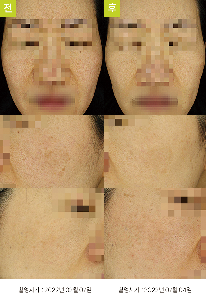 대구난치성기미 오오피부과 - 연한 흑자증·옅은 기미 증례16 정면 전후
