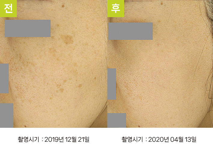 대구난치성기미 오오피부과 - 다발성 흑자증·일광흑자 증례17 전후