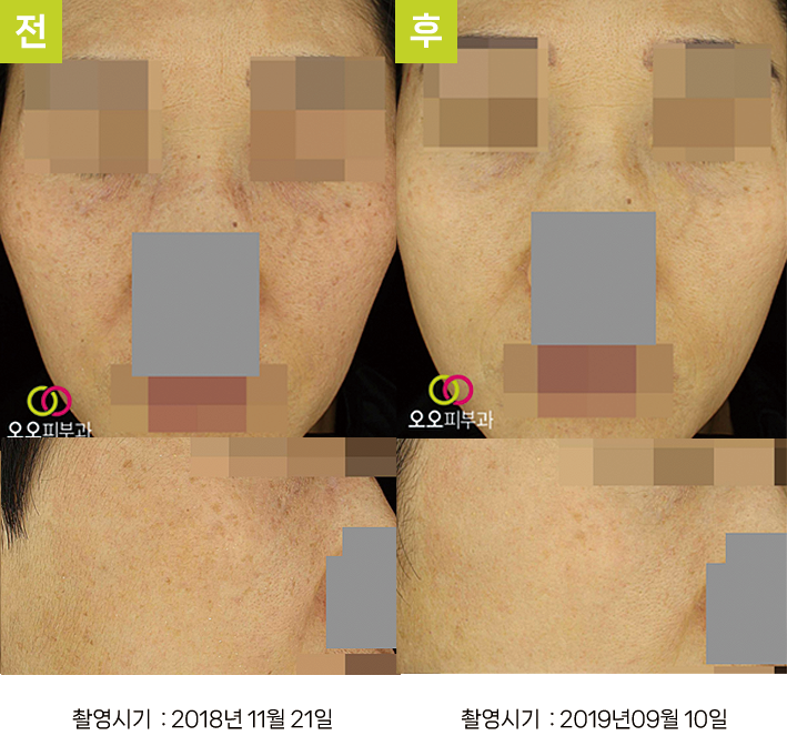 대구난치성기미 오오피부과 - 기미·흑자증·오타양반점 증례2 정면 전후