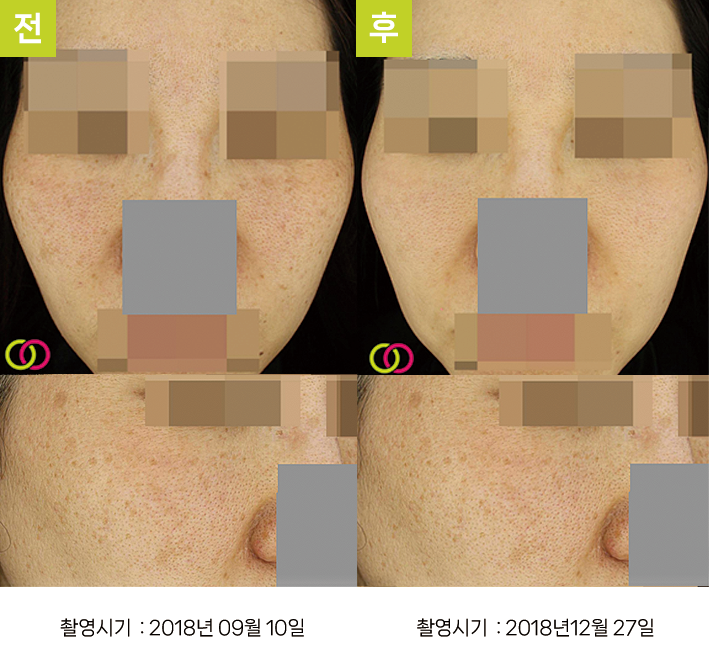 대구난치성기미 오오피부과 - 혼재 색소 증례3 정면 전후