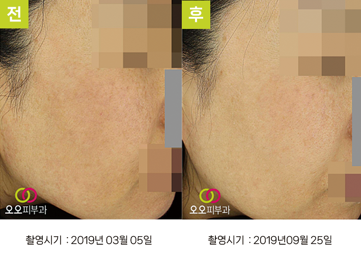 대구난치성기미 오오피부과 - 옅은 기미 증례4 측면 전후