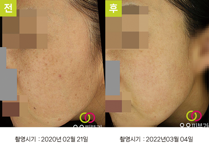 대구난치성기미 오오피부과 - 옅은 기미 증례5 측면 전후