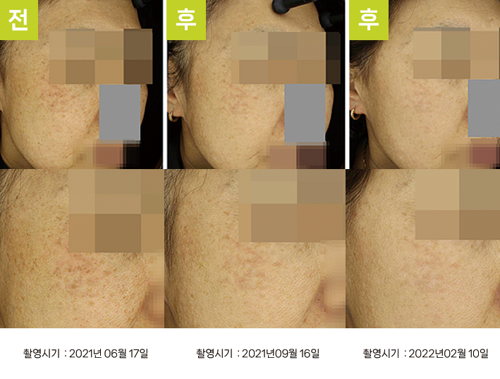 대구난치성기미 오오피부과 - 기미·오타양반점 증례6 측면 3시점