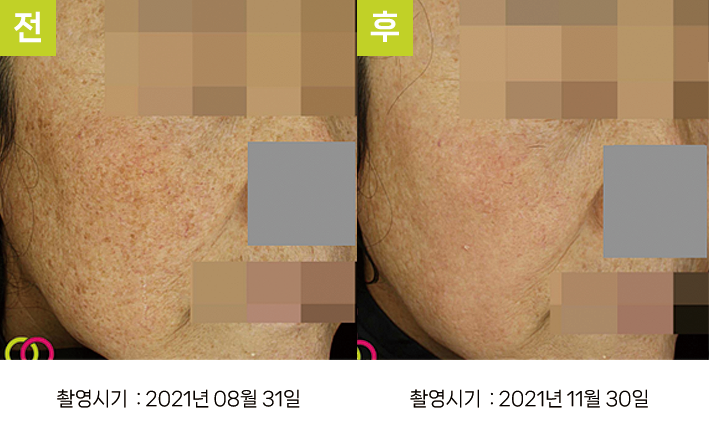 대구난치성기미 오오피부과 - 다발성 흑자증·광노화 증례7 전후