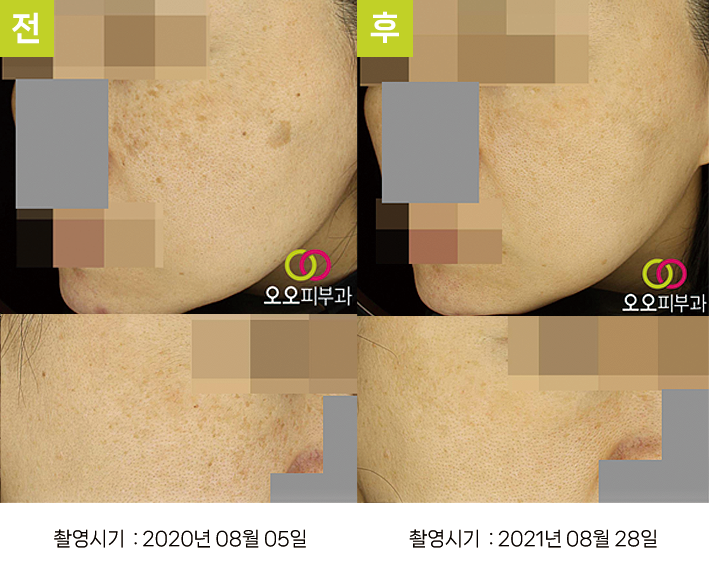 대구난치성기미 오오피부과 - 혼재 색소 증례8 측면 전후