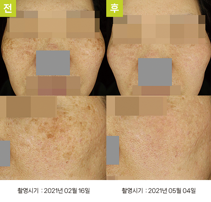 대구난치성기미 오오피부과 - 혼재 색소 증례9 정면 전후