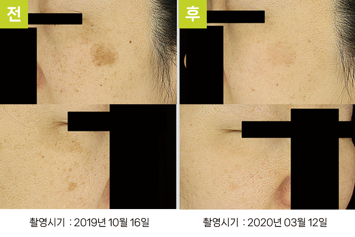 오오피부과 기미 증례 - 눈가 기미·일광흑자 증례1 전후
