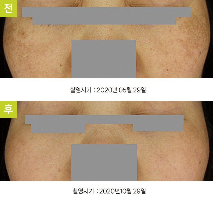 오오피부과 기미 증례 - 양광대 기미 증례10 전후