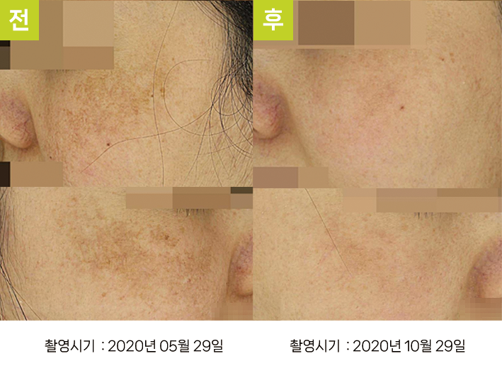오오피부과 기미 증례 - 양광대 기미 증례10 전후