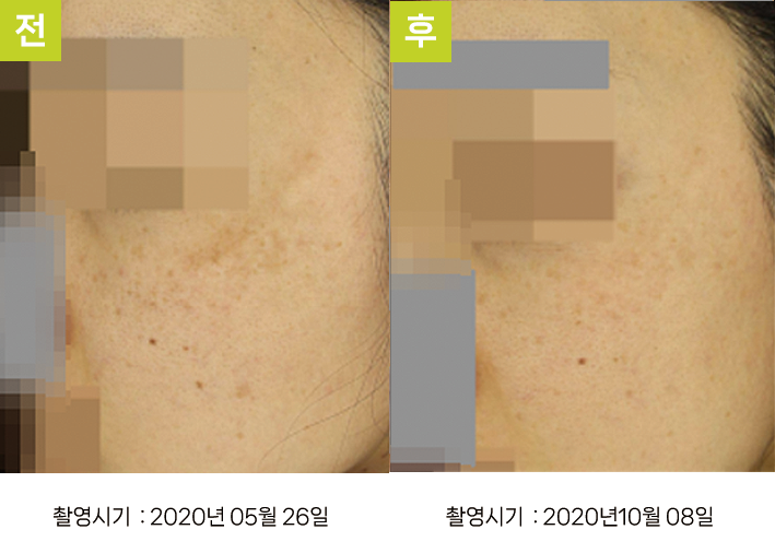 오오피부과 기미 증례 - 양광대 기미 증례10 전후