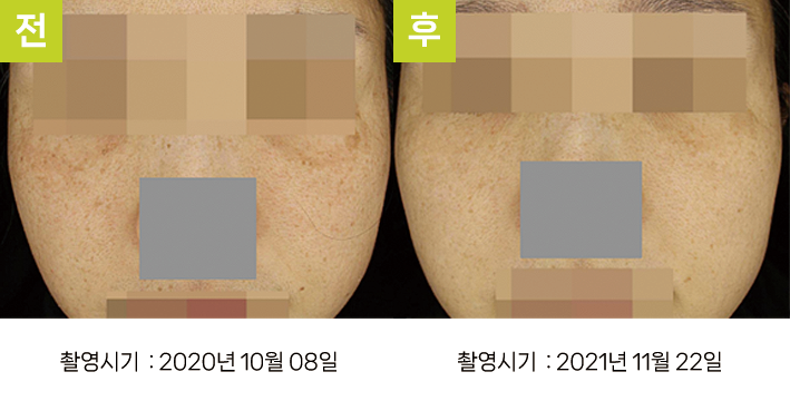 오오피부과 기미 증례 - 눈가 기미 증례12 전후
