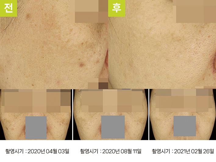 오오피부과 기미 증례 - 양뺨 기미 듀얼토닝 증례13 경과