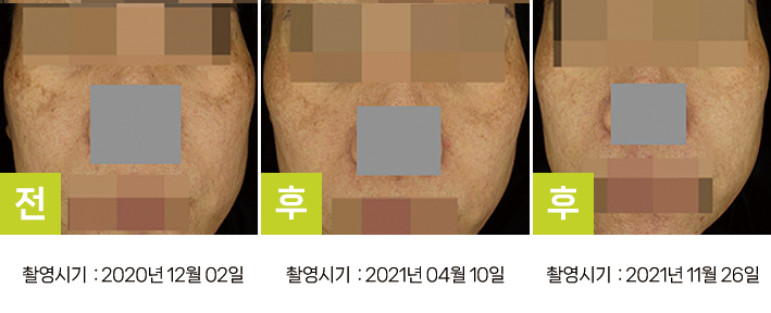 오오피부과 기미 증례 - 타 의원 시술 후 악화 기미 증례14 3시점
