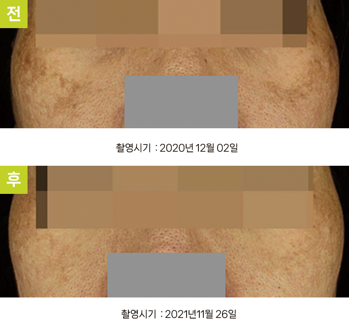 오오피부과 기미 증례 - 타 의원 시술 후 악화 기미 증례14 전후