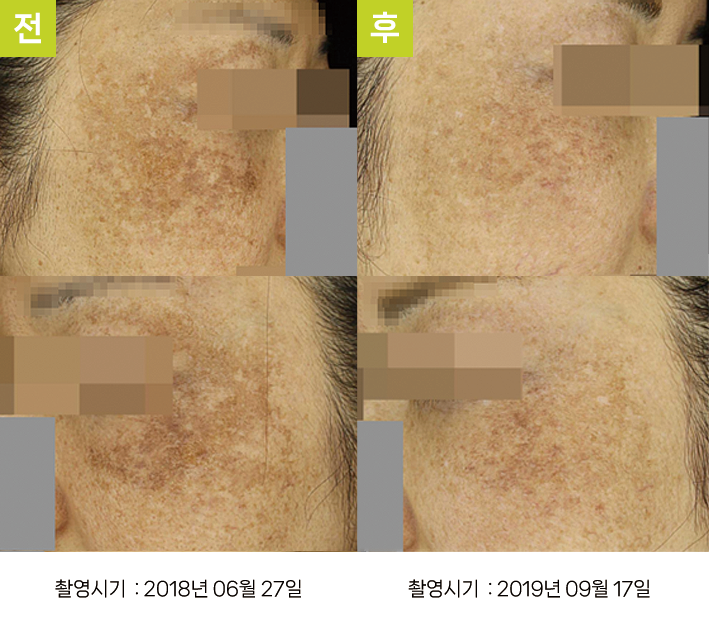 오오피부과 기미 증례 - 타 의원 IPL 후 기미 증례15 3시점