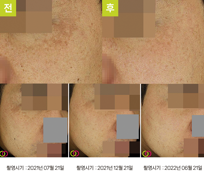 오오피부과 기미 증례 - 눈가 기미 듀얼토닝 증례4 3시점