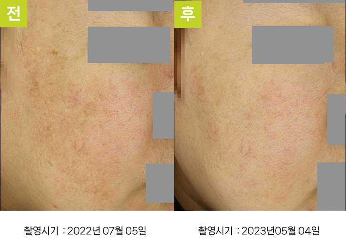 오오피부과 기미 증례 - 양뺨 기미 증례5 전후