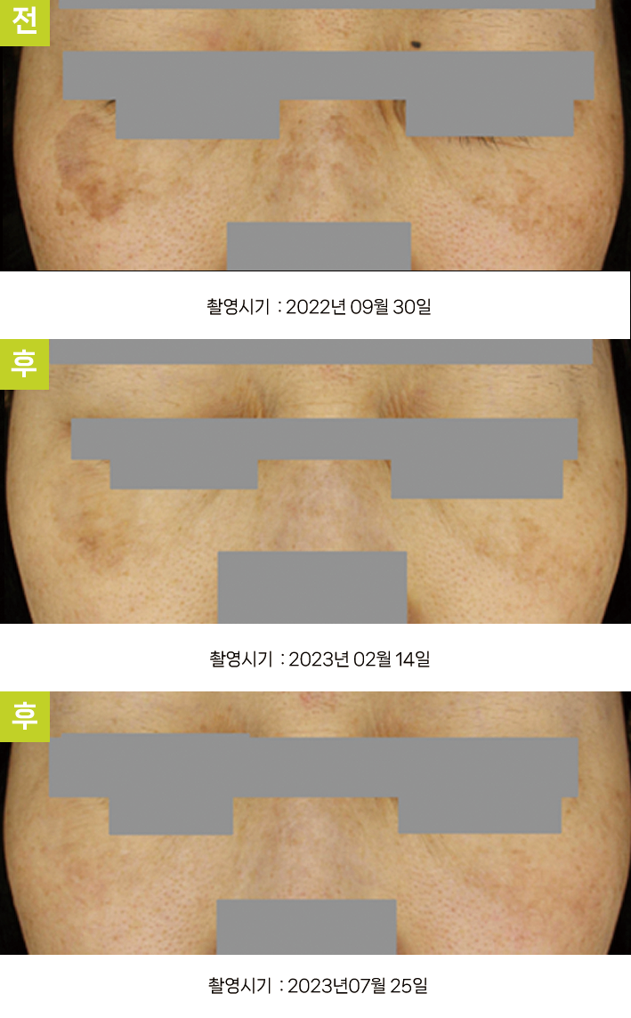 오오피부과 기미 증례 - 기미·큰 일광흑자 증례6 정면 3시점