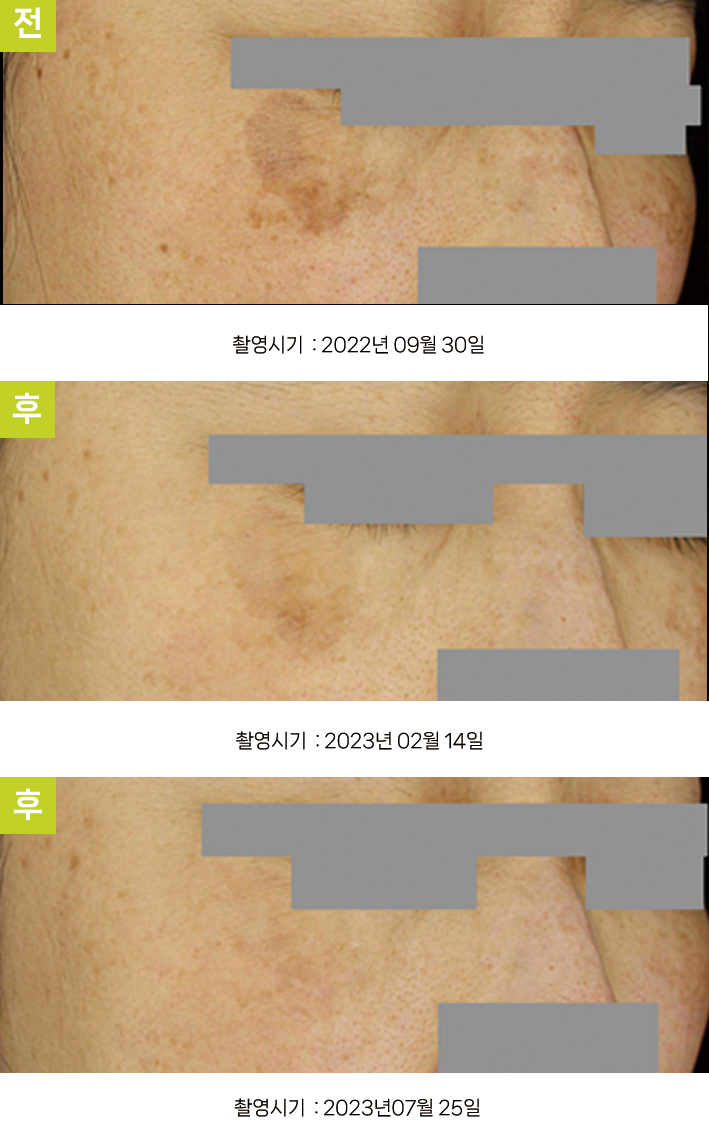 오오피부과 기미 증례 - 기미·큰 일광흑자 증례6 볼 3시점