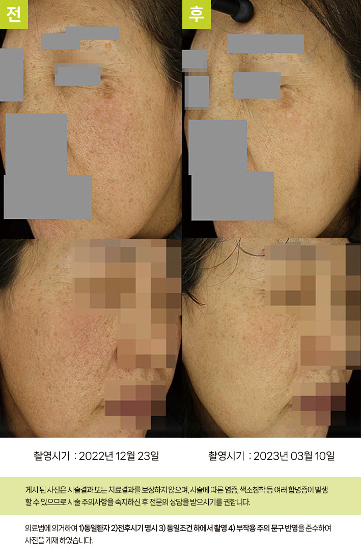 오오피부과 기미 증례 - 양뺨 가장자리 기미 증례8 전후