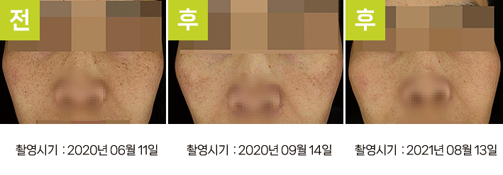 오오피부과 레이저토닝 증례 - VSEM 증례1 정면 3시점