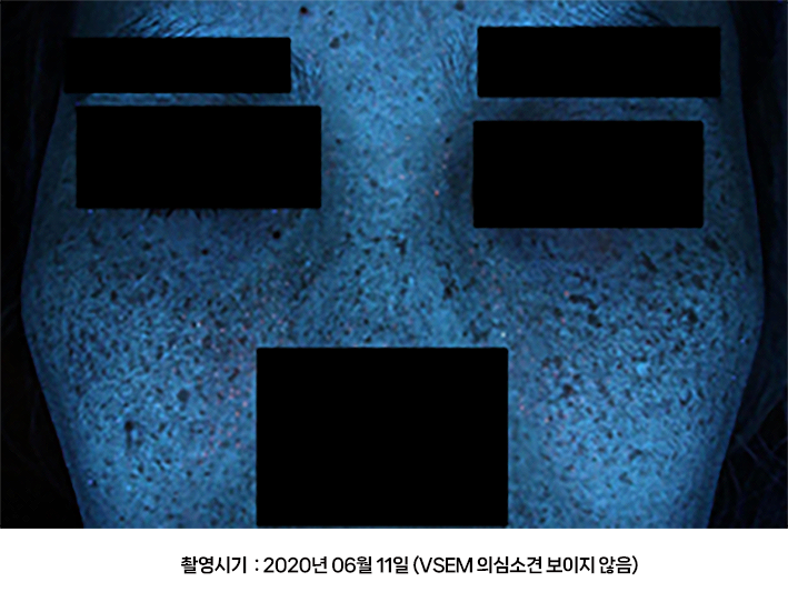 오오피부과 레이저토닝 증례 - VSEM 증례1 UV광